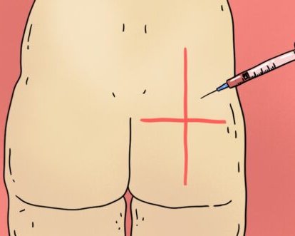 Как делать укол в ягодицу: очень подробная инструкция
