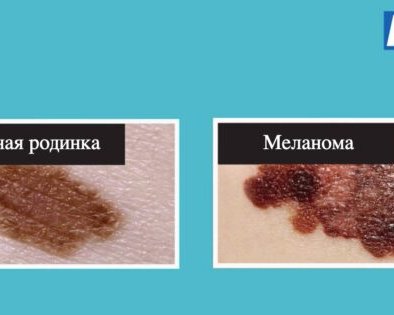 Что нужно знать об удалении родинок и когда его стоит делать